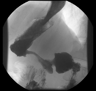 Тотальный рак желудка