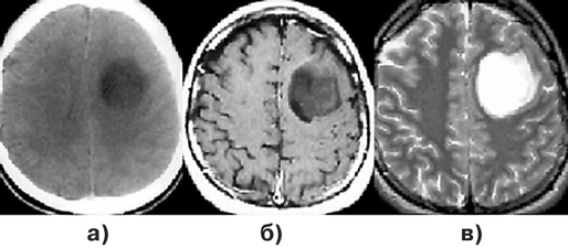 Астроцитомы